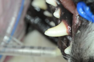 Broken tooth that has underlying dentin exposure