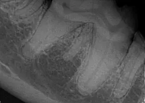 3 rooted mandibular 1st molar tooth