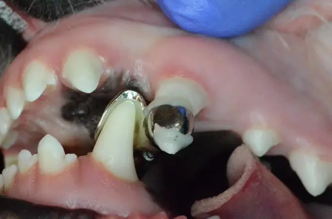 example of a passive orthodontic appliance