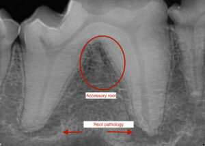 3 rooted mandibular 1st molar with pathology